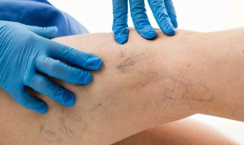 დასახელდა მთავარი ნიშნები, რითაც მიხვდებით, რომ სისხლძარღვებში საშიში თრომბი გაქვთ